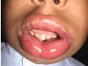 Akuttdermatologi (Kilde: CMAJ 2005;173(11):1317-9. Foto Dr. Brenda Moroz)