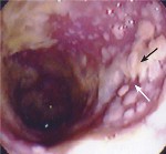 Clostridium Difficile (Kilde: Am Fam Physician 2005;71:921-28)