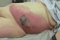 Necrotising fasciitis (Foto: bmj.com)