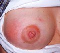 Mastitt hos en ammende (Foto: www.tidsskriftet.no)