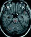 PET-forandringer ved migrene (Kilde: BMJ 2006;332:25-29.)