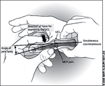 UCL-skade (skiers thumb) (kilde: www.aafp.org)