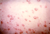 Herpes zoster (kilde: BMJ  2007;334:1211-1215)