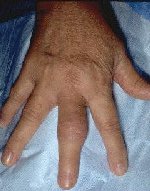 Bilde av hovent fingerledd (Foto: www.mdchoice.com)