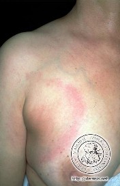 Erythema migrans (kilde: DOIA)