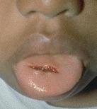 Bilde av 4-�ring med kutt i tungen (Foto: www.mdchoice.com)